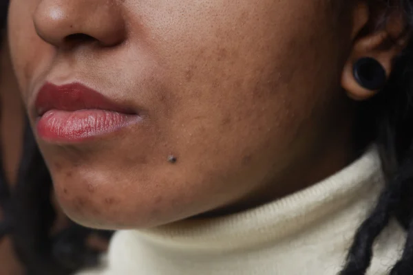 acne-scars-close-up-2021-09-24-04-13-31-utc