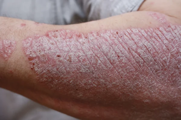 close-up-macro-of-psoriasis-skin-autoimmune-dise-2023-04-11-01-15-19-utc